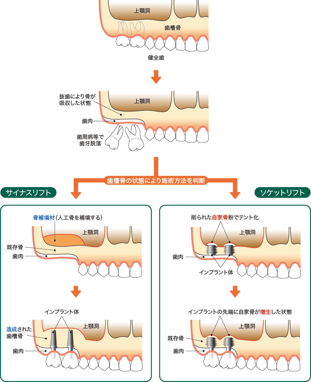 サイナスリフトとソケットリフトの違い