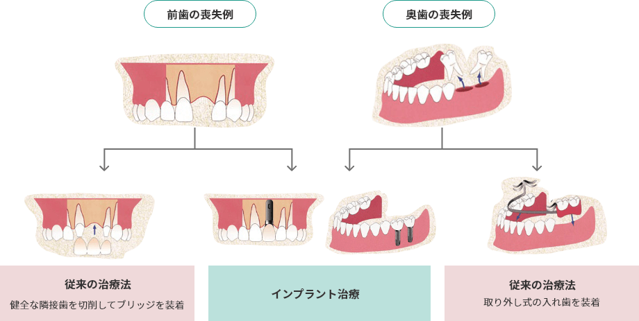 歯を喪失した時の治療例